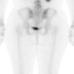 hot-kidneys-bone-scan.png